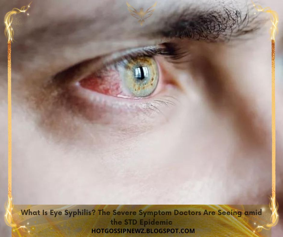 What Is Eye Syphilis The Severe Symptom Doctors Are Seeing amid the STD Epidemic