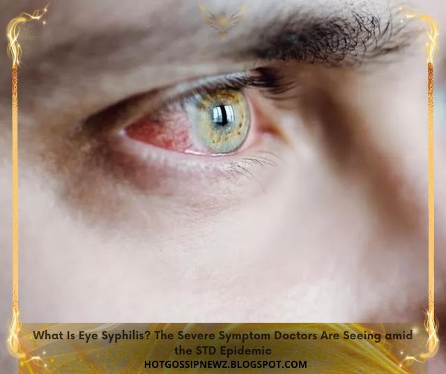What Is Eye Syphilis? The Severe Symptom Doctors Are Seeing amid the STD Epidemic