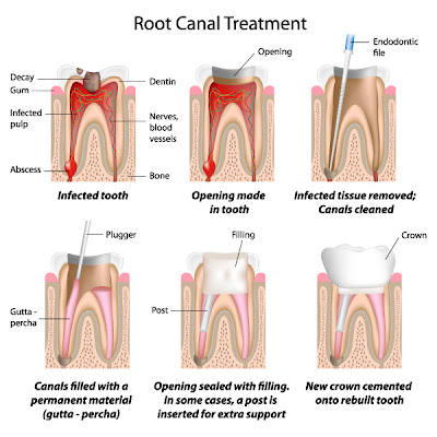 Root Canal Treatment