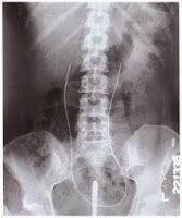 retrograde urogram