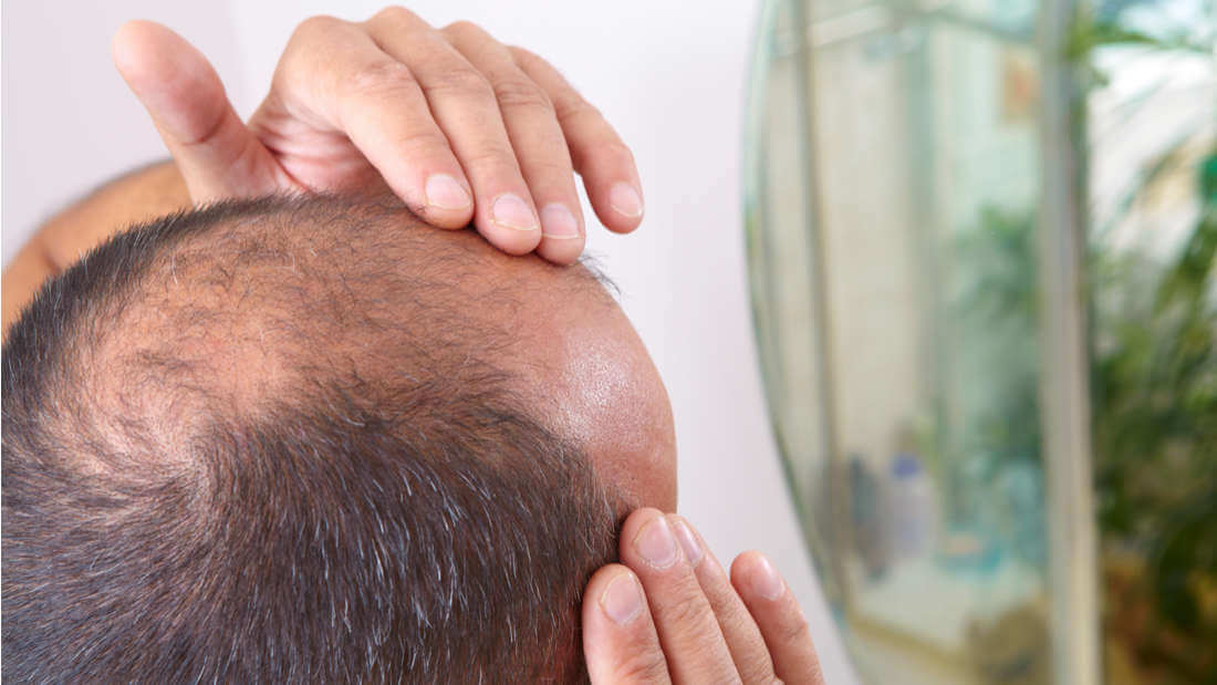 Scientists Might Have Accidentally Found A Possible Treatment For Alopecia
