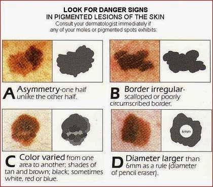 melanoma kanker kulit