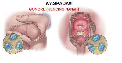 Penderita Kencing Nanah Dan Obatnya