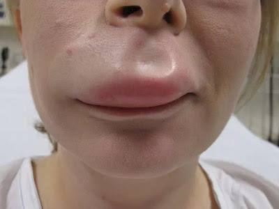 Gangguan dan Gejala Angioedema 