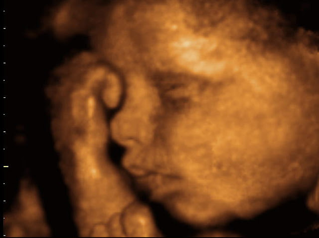 3d Sonogram1