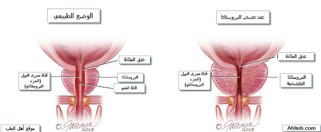 تضخم-البروستاتا