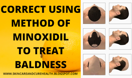 CORRECT USING METHOD OF MINOXIDIL TO TREAT BALDNESS, Minoxidil for Men and Women  |  Treatment of all kinds of Baldness Round Patches and Itchy Scalp