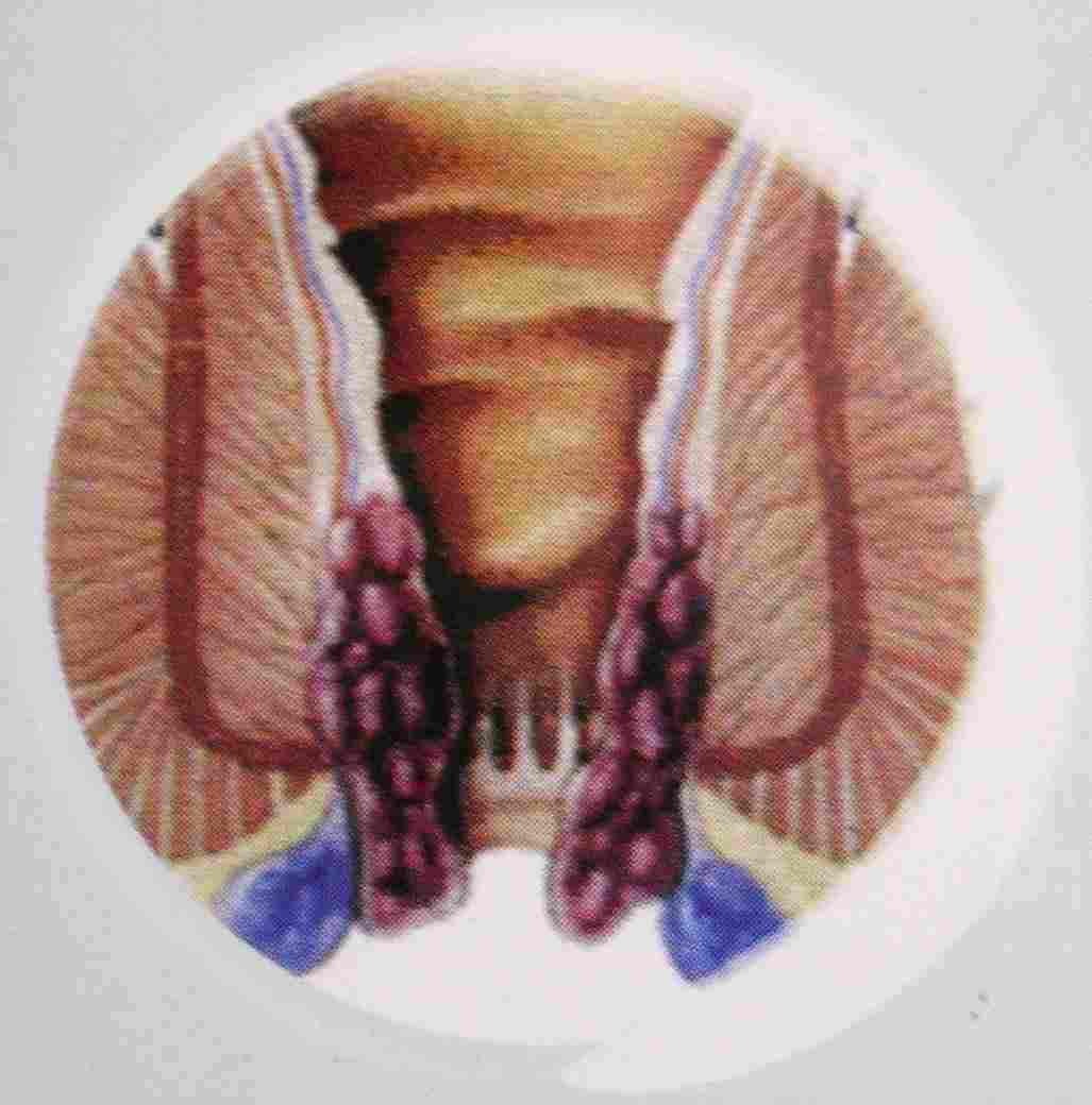 Obat Wasir Yg Ampuh