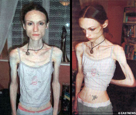 An anorexic woman who dropped to threeandahalf stone after walking up to 