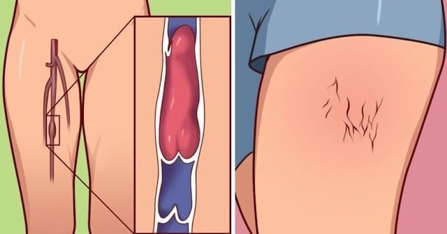 8 Signs of a Blood Clot You Should Never Ignore, According to Doctors