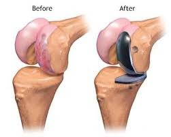 Knee replacement orthopedic in Mumbai