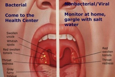 White Spots on Throat: 6 Common Causes (Images Included) 