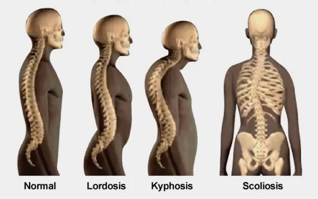 kelainan tulang, penyakit tulang, penyebab, pengertian, lordosis, kifosis, skoliosis, osteoporosis, rematik, polio, rakitis, ipa, pelajaran sekolah