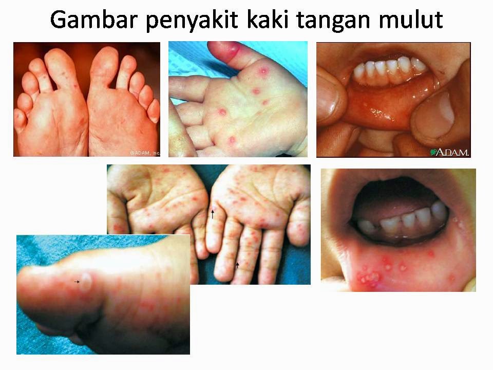 Cik Cerry Penyakit Kaki  Tangan Mulut HMFD