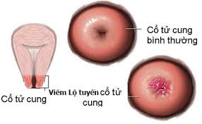 Viêm lộ tuyến cổ tử cung là gì