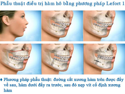 Phương pháp phẫu thuật hàm hô