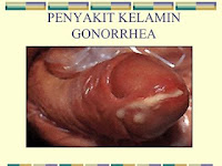 Obat Tetes Mata Gonore (Kemaluan Bernanah)