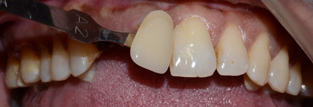 Shade Matching with adjacent teeth