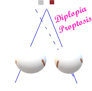 Diplopia (double vision)