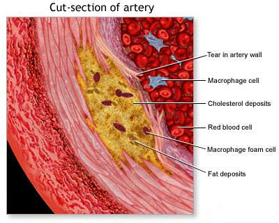 Illustration of Atherosclerosis