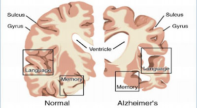 Perbedaan Otak normal dan yang sudah menderita Alzheimer