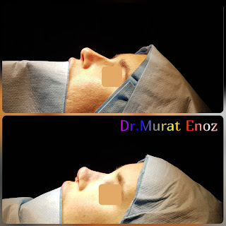 Micromotor Assisted Revision Nose Job, Micro-Motor Assisted Revision Rhinoplasty Operation,Revision Nose Aesthetic Operation in Turkey,