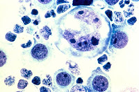 Anaplastic Large Cell Lymphoma (ALCL)