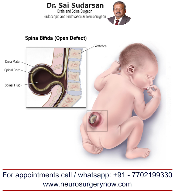 Spina Bifida