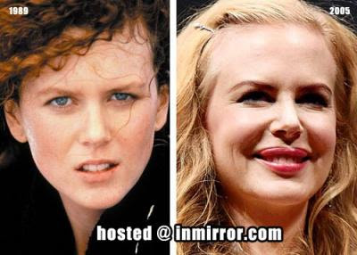 Nicole Kidman Plastic Surgery Before And After