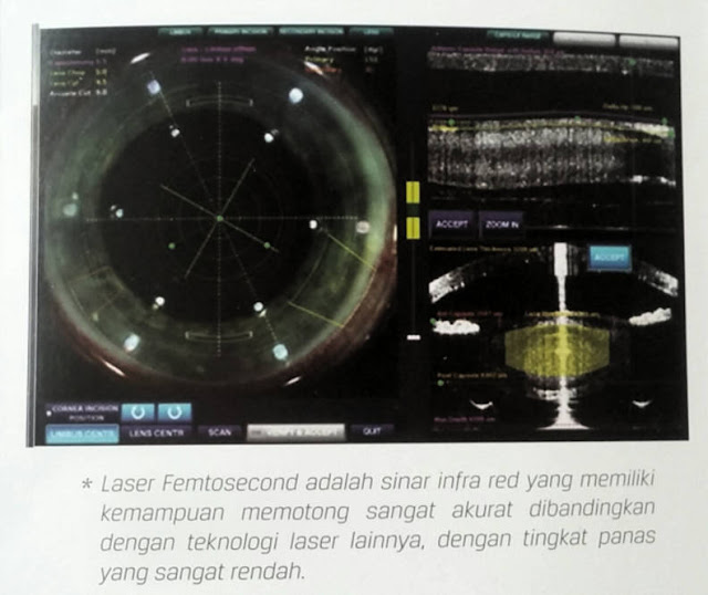 femtosecond laser pada operasi katarak tanpa pisau bedah