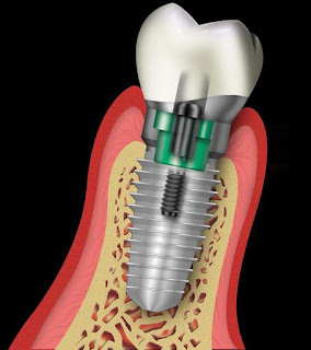 rang-su-vinh-vien-implant