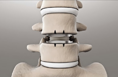 Lumbar Artificial Disk Replacement