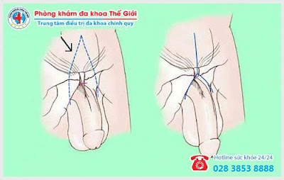  Hình ảnh kéo dài dương vật ở nam giới