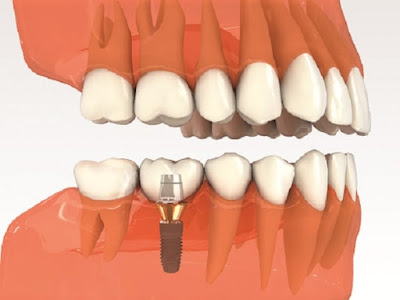 Trồng răng số 7 hết bao nhiêu tiền với răng implant 2
