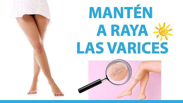 REMEDIOS PARA LAS VARICES Y PIERNAS PESADAS