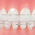 Một số ưu điểm vượt trội mà kỹ thuật niềng răng sứ mang lại