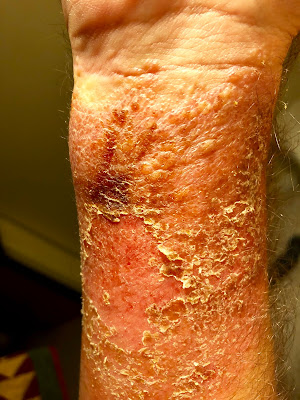 rash from poison sumac