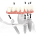 Cấy ghép răng implant là gì?