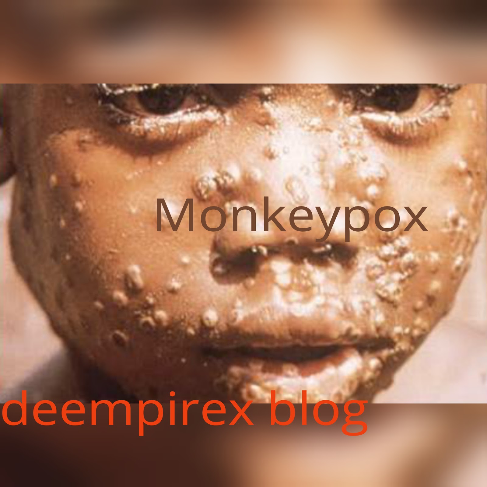 Signs and Symptoms of Monkeypox | The Future