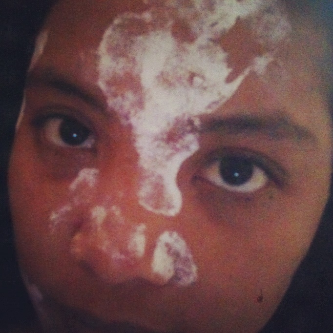 Hidayu's Journal: Chicken pox!!!