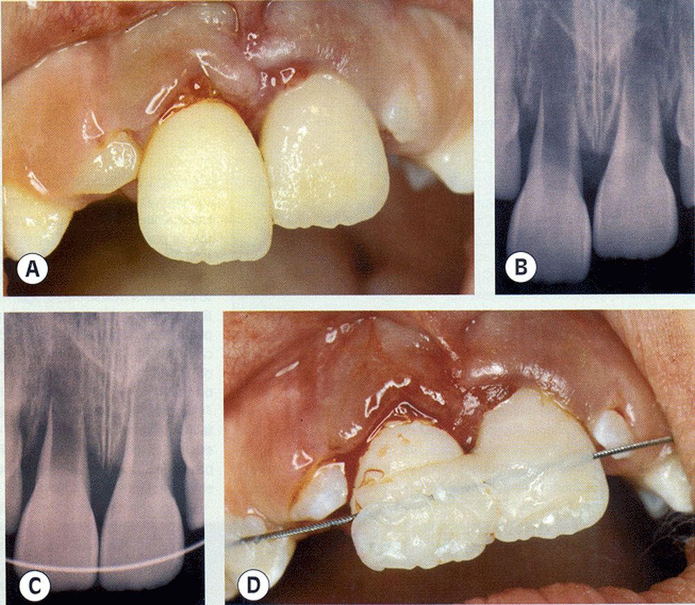 Traumatismo Dental