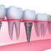 Chi phí trồng răng implant bao nhiêu