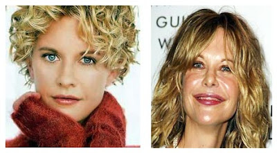 Meg Ryan Plastic Surgery