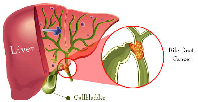 Prevent Gall Stone Permanently