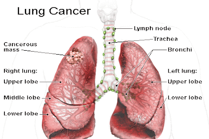 Lung Cancer  Causes, Symptoms And Treatment