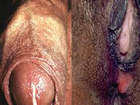 CARI OBAT SIPILIS TRADISIONAL ALAMI HERBAL MANJUR