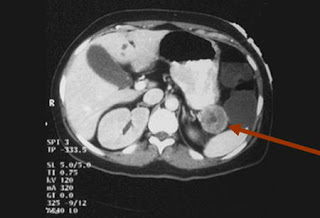 cancer pancreatic