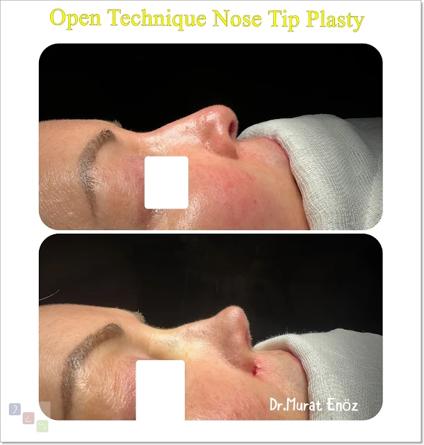 Nose tip lifting in İstanbul,Tip plasty in İstanbul,Open technique tip plasty operation in İstanbul,Nose tip plasty operation in İstanbul,Nose tip surgery in Turkey,Nose tip reshaping in İstanbul,