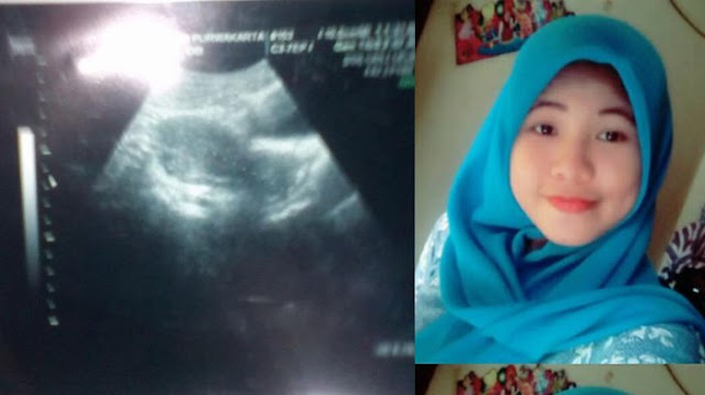 Wanita Ini Ceritakan Bahaya KB Suntik, 3 Bulan Tidak Haid, Dia Kaget Saat Dokter Bilang Rahimnya. 