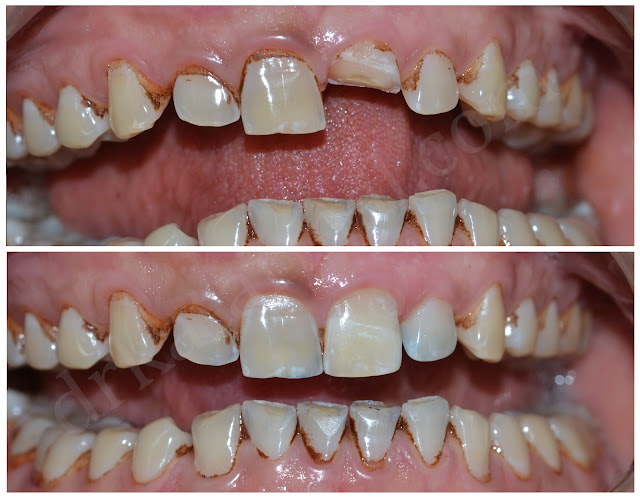 Treatment of Dental Trauma || Dr. Bharat Katarmal Dental Clinic || Cosmetic Dental Clinic